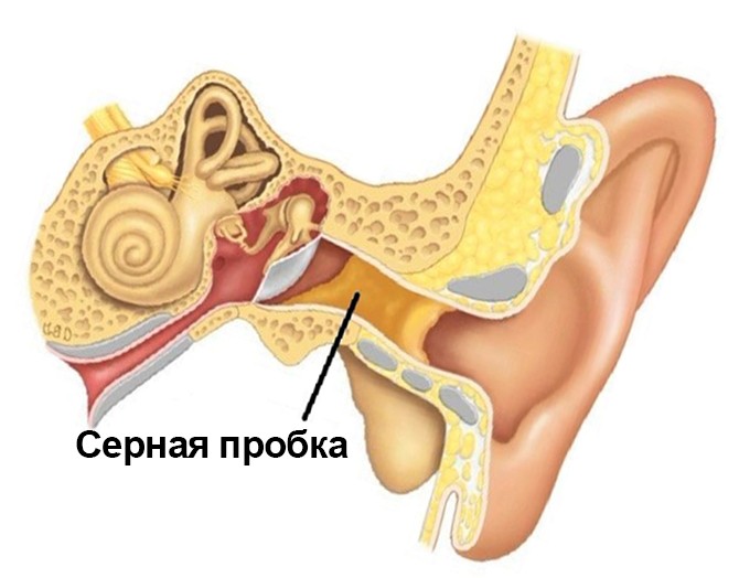 удаление серной пробки из уха